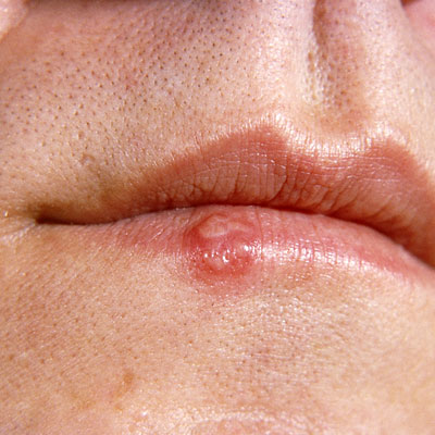 Cold Sores Fairfield Dermatology